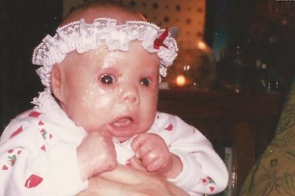 Rođena je sa CRVENIM MRLJAMA po telu, doktori su rekli da neće preživeti detinjstvo, a danas ima 18 godina i lice kakvo doktori NIKAD dosad NISU VIDELI (VIDEO)