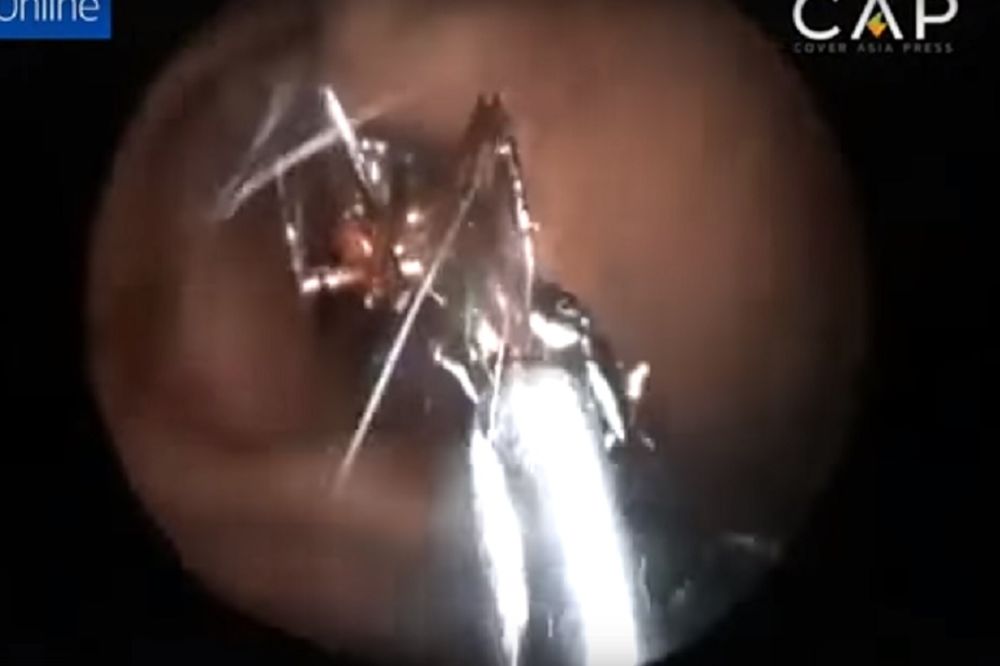 Ma grozno: Lekari izvadili 1.000 mrava iz uva devojčice (VIDEO)