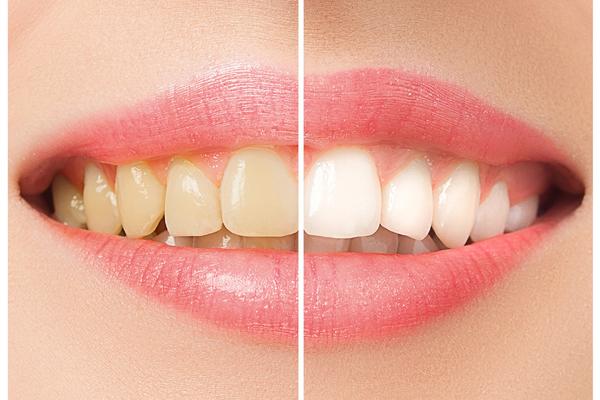 KAKO DA SPREČIMO POJAVU ŽUTIH ZUBA? Stomatolog daje JEDNOSTAVAN i KORISTAN SAVET